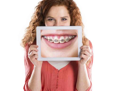 Invisalign And Braces by All Smiles Dental